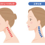 「ストレートネック」と「正常な首」のイラスト。ストレートネックの女性は首が真っ直ぐでやや前に出ており、首の骨が赤く強調されている。正常な首の女性は緩やかなS字カーブを描いており、首の骨が青く強調されている。